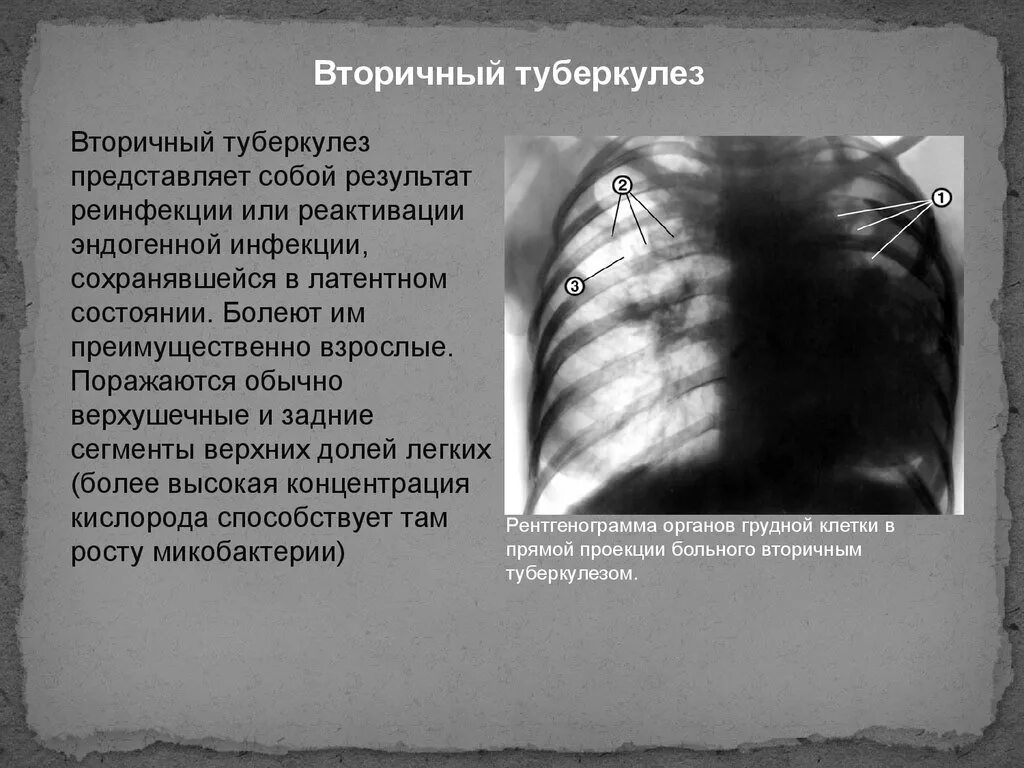 Вторичныи туберкулёза. Вторичный туберкулёз лёгких.