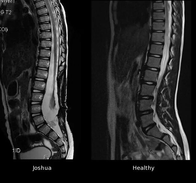 Spine mri