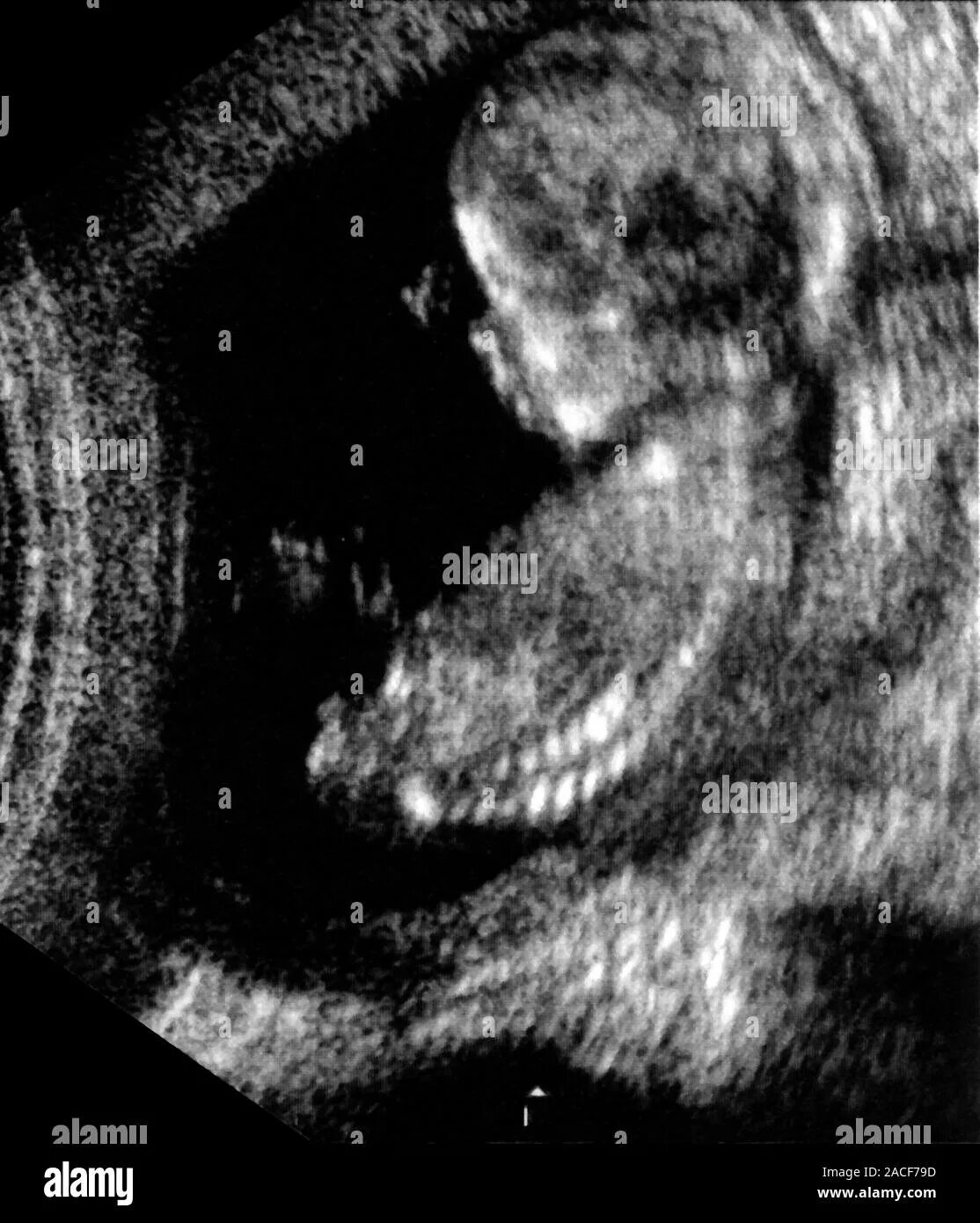 Эмбрион на 13 неделе беременности УЗИ. УЗИ 13-14 недель беременности. Снимки УЗИ на 13 неделе беременности. Узи ребенка на 13 неделе