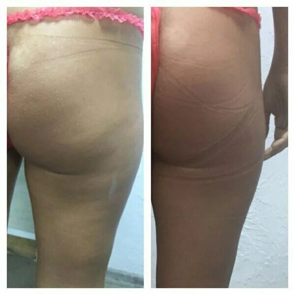 Целлюлит до и после обертывания. Липодистрофия целлюлит. Обертывание до и после. Бандажное обертывание до после. Обертывание результаты до и после.
