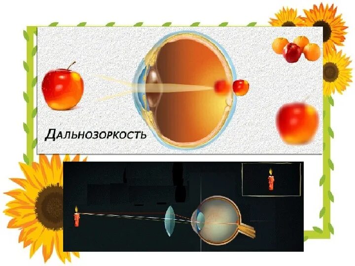 Нарушение зрения биология 8 класс. Презентация нарушение зрения биология 8 класс. Болезни глаз биология 8 класс.