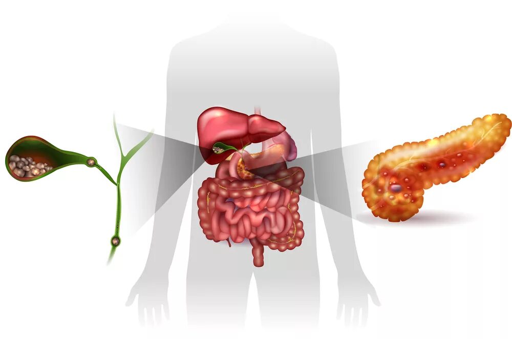 Острый панкреатит анатомия. Камни в поджелудочной железе. Уплотнение в поджелудочной железе. Поджелудочная железа на прозрачном фоне. Хронический холецистит поджелудочной железы
