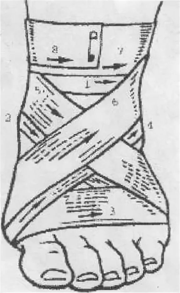 Восьмиобразная на голеностопный сустав. Восьмилбразная повязкамнастопе. Восьмиобразная повязка на колено. Восьмиобразная повязка на голеностоп.