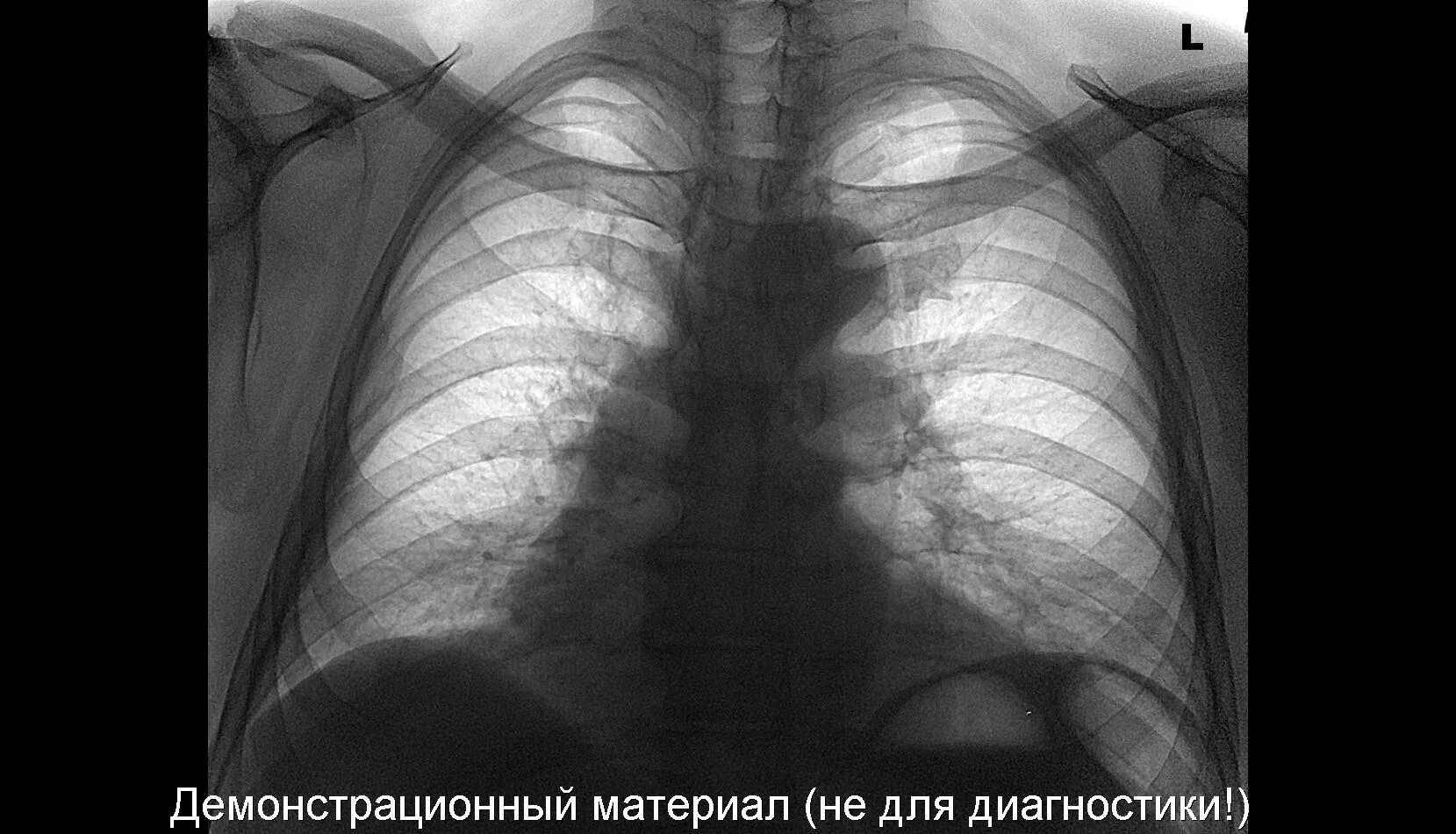 Что значит аорта уплотнена на флюорографии. Праволежащая аорта на рентгене. выпуклая дуга аорты на рентгенограмме. 2 дуга на рентгенограмме. тень главного бронха аорты.