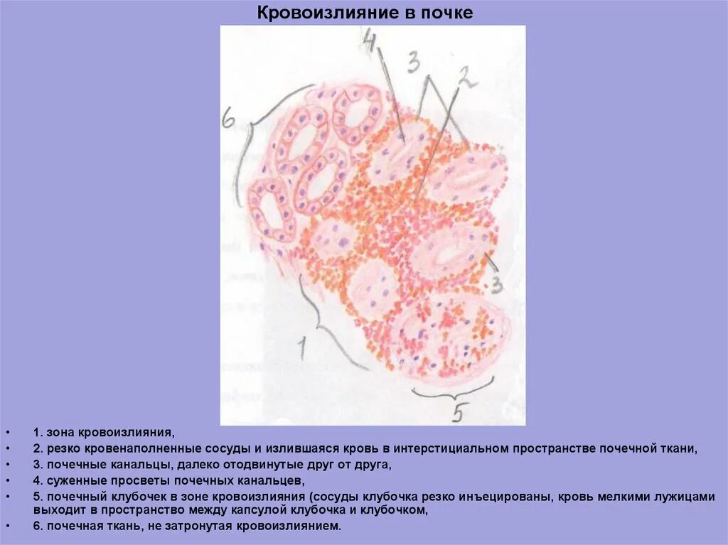 Печень при хроническом венозном застое. Мускатная печень гистология. Мускатная печень микропрепарат патанатомия. Хроническое венозное полнокровие печени мускатная печень. Мускатный цирроз печени.