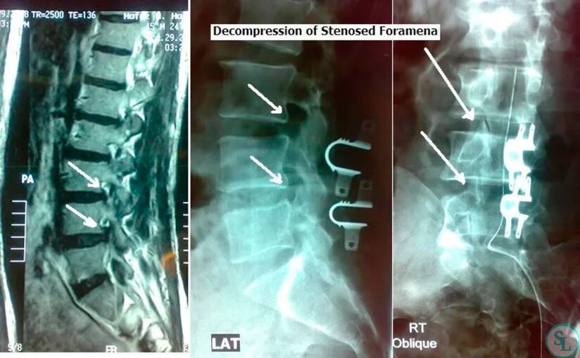 Операция по замене позвоночника. Декомпрессия Корешков позвоночника. Декомпрессия Корешков l5 s1. Декомпрессия позвоночника операция. Декомпрессивно-стабилизирующая операция на позвоночнике.