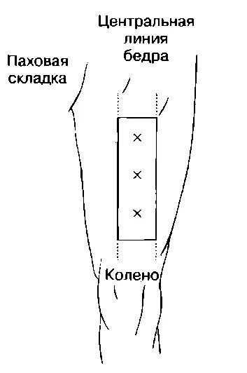 Схема введения укола в бедро. Укол в бедро внутримышечно куда колоть. Как делать укол внутримышечно в бедро самому себе. Как делаются уколы внутримышечно в бедро.