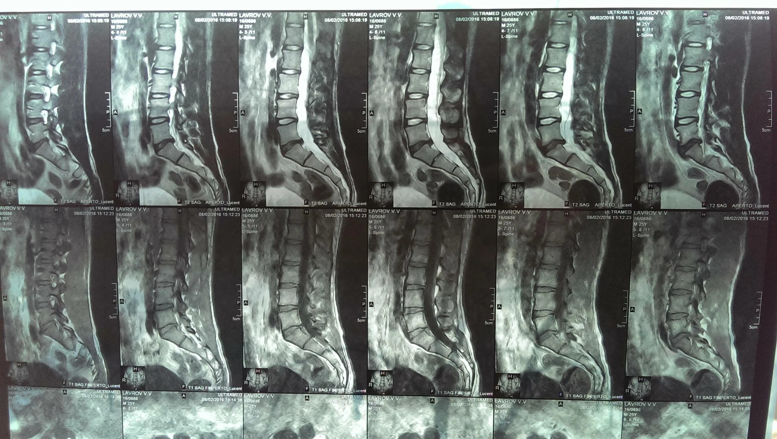 Мрт пояснично крестцового отдела позвоночника цена москва. Спондилез поясничного отдела рентген. Спондилез на мрт позвоночника. Спондилоартроз пояснично-крестцового отдела позвоночника мрт. Спондилоартроз поясничного отдела позвоночника мрт.