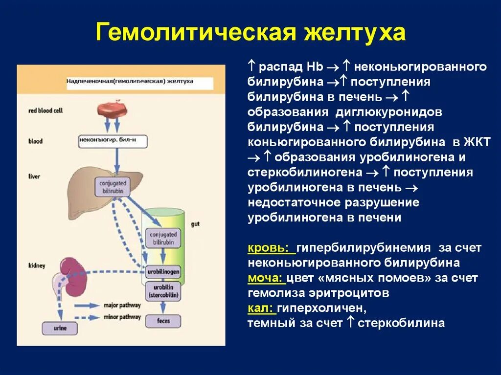 Схема катаболизма билирубина при гемолитической желтухе. Схема катаболизма билирубина при геомлитической желтухи. Механизм образования гемолитической желтухи. Механизм развития надпеченочной желтухи. Распад мочи