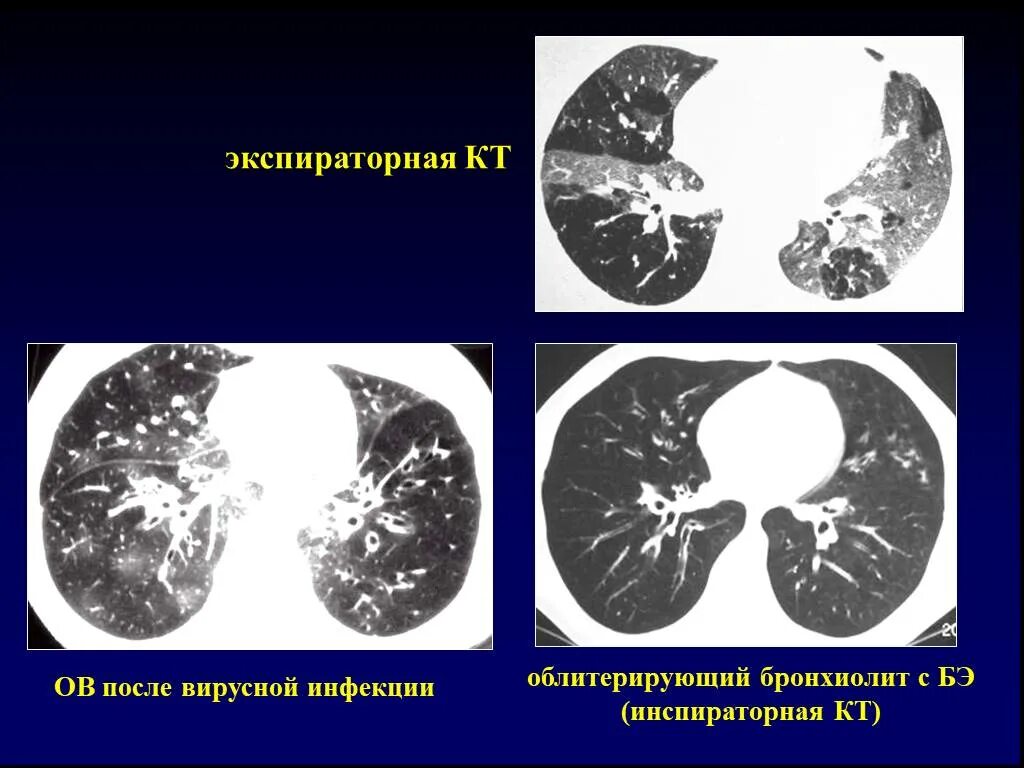 Дерева в почках в легких кт. Бронхиолит на кт. Фиброзирующий бронхиолит на кт. Аспирационный бронхиолит кт. Констриктивный бронхиолит на кт.