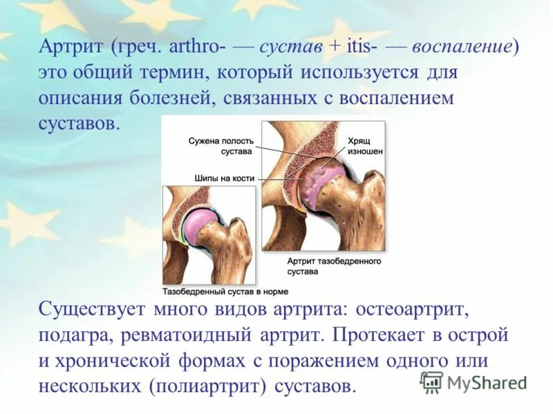 Воспаление сочленений. Воспаление сочленений. Сакроилеит крестцово-подвздошного сочленения. Воспаление сочленений. Артрит тазобедренного сустава симптомы.