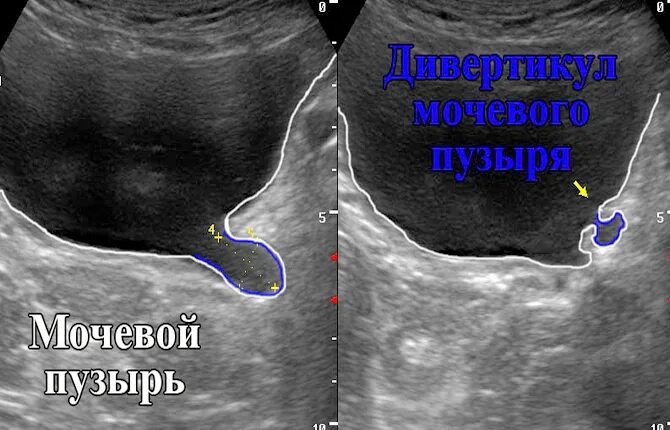 Дивертикул мочевого пузыря что это такое. Дивертикул мочевого пузыря на узи. дивертикулёз мочевого пузыря на узи. дивертикулез мочевого пузыря на узи. псевдодивертикулы мочевого пузыря на узи.
