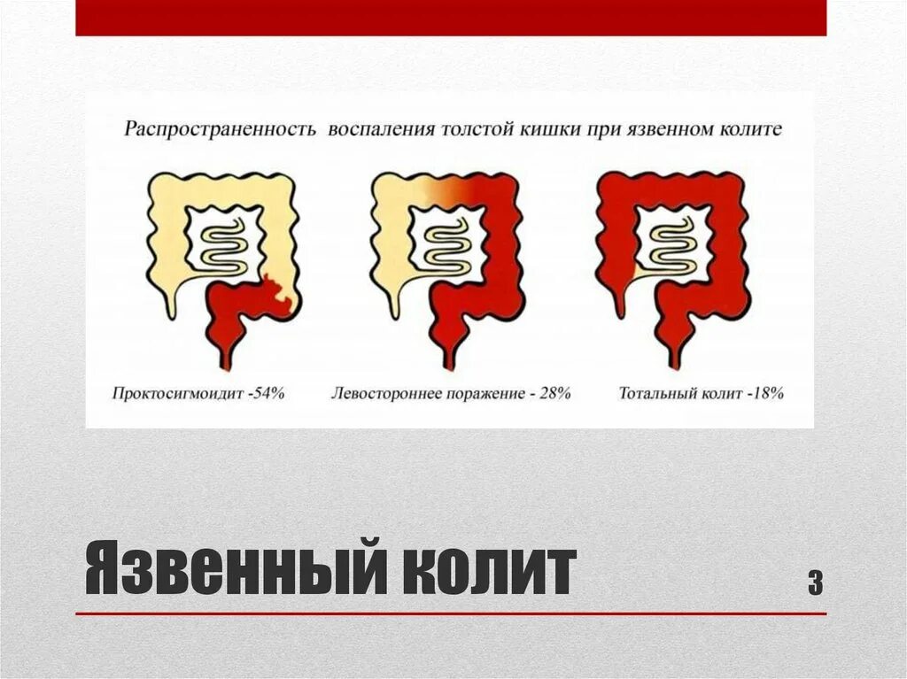 Язвенный колит лечение. Неспецифический язвенный колит клинические рекомендации. Неспецифический язвенный колит диагностика. Заболевания сопутствующие язвенному колиту. Хирургическое лечение язвенного колита.