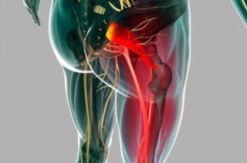 Люмбоишиалгия седалищного нерва. Ишиас и синдром грушевидной мышцы. Седалищный нерв спазм мышц.
