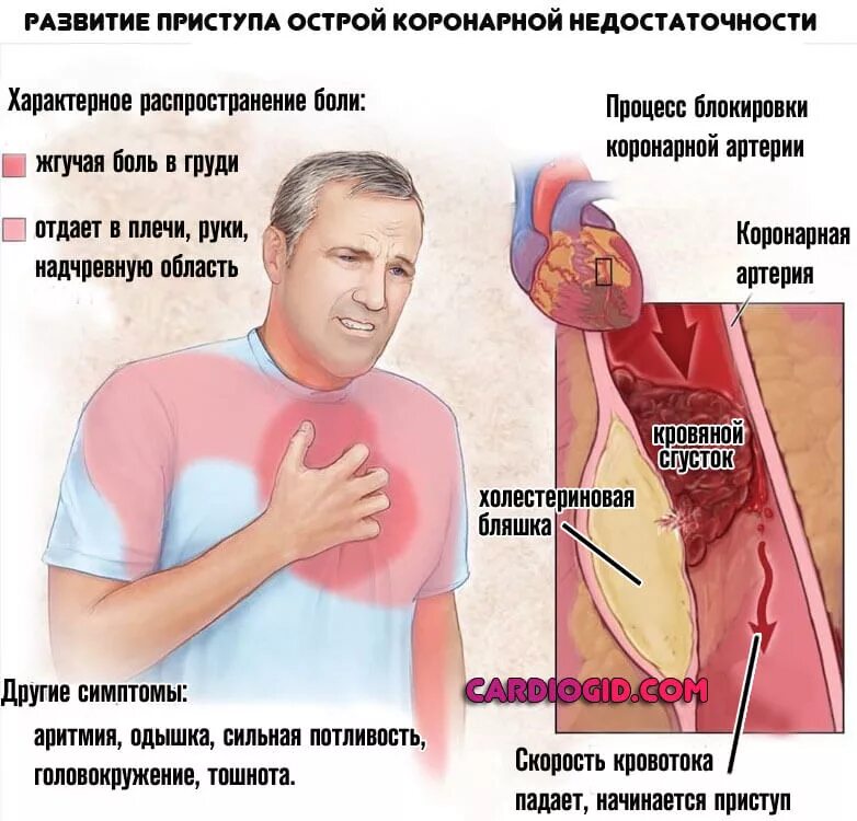 Боли в области сердца у мужчины. Острая коронарная недостаточность симптомы. Синдром острой коронарной недостаточности симптомы. Приступ стенокардии.