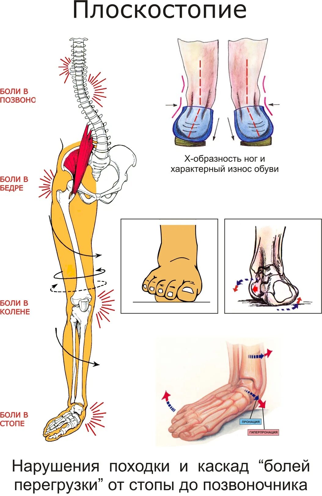 Боль от бедра до стопы. Плоскостопие вид сбоку. Патогенез плоскостопия. Стопа плоскостопие. Схема стопы плоскостопие.