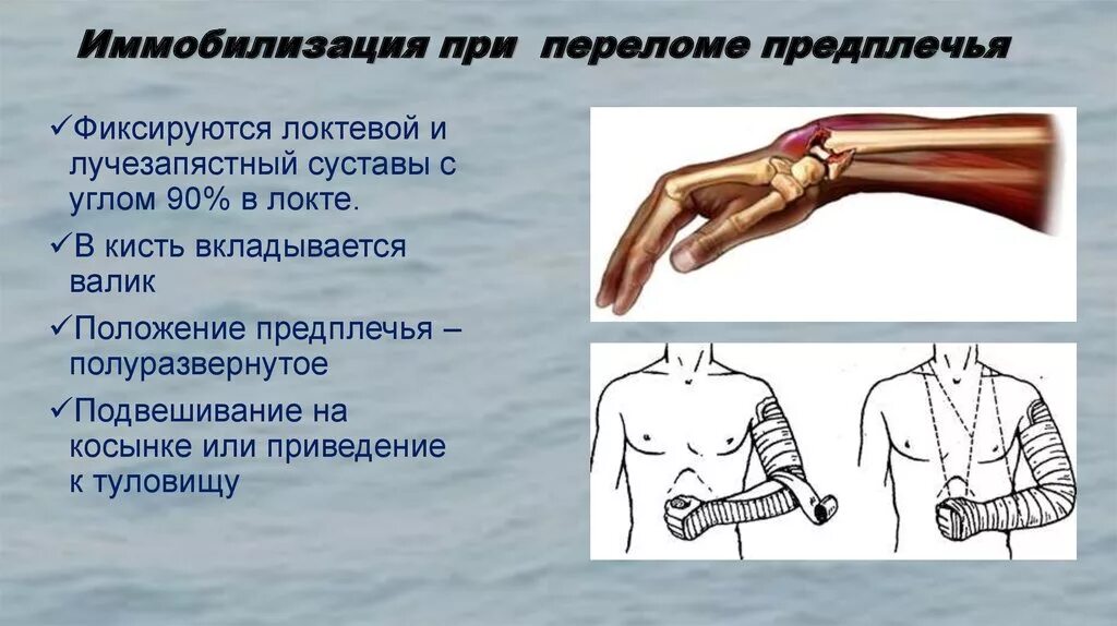 Если при открытом переломе имеется повреждение артерии. Технология транспортной иммобилизации при переломах предплечья. При переломе костей предплечья иммобилизируют. Транспортная иммобилизация при переломе костей предплечья. Иммобилизация конечности при переломе костей предплечья.