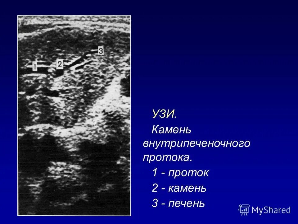 Камни в протоке печени