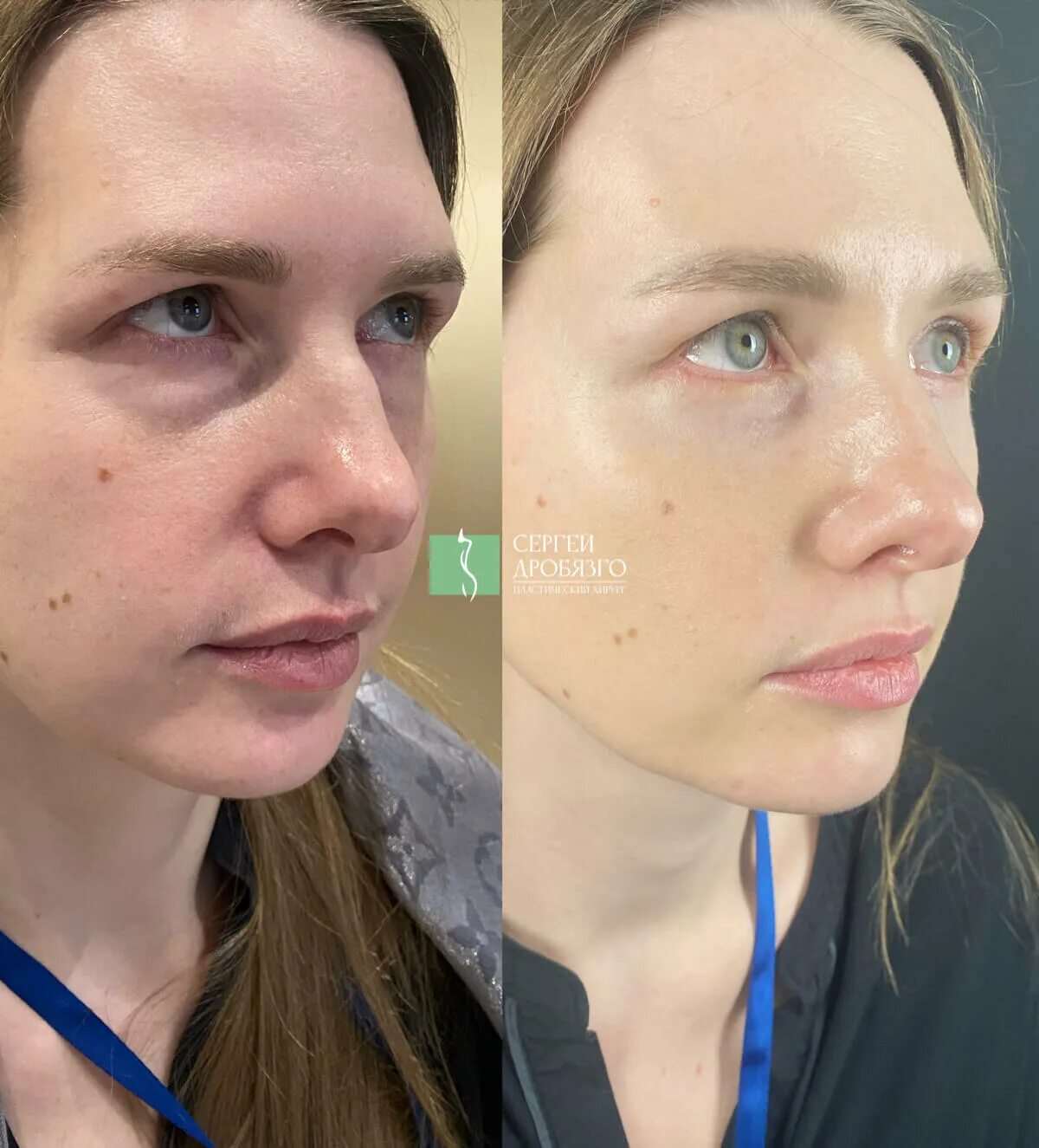 Переходящая операция. Пластика глаз. операция на нижнюю треть лица.