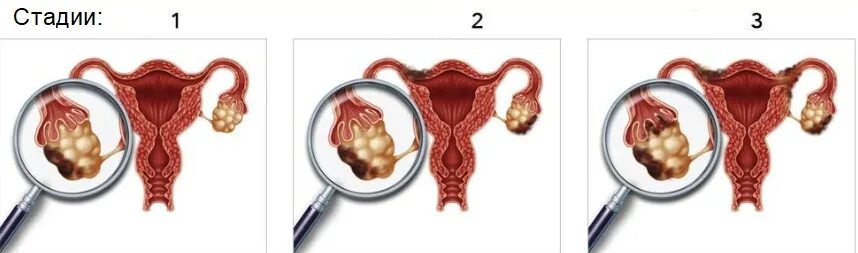 Опухоль яичника 4 стадии. Стадии опухоли яичников. Степени рака яичников