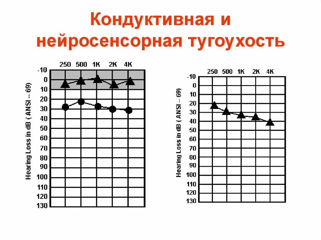 Подострая тугоухость. Кондуктивная тугоухость является аудиометрическим признаком. кондуктивный тип снижения слуха. кондуктивная и нейросенсорная тугоухость акуметрия. кондуктивная тугоухость клинические рекомендации.