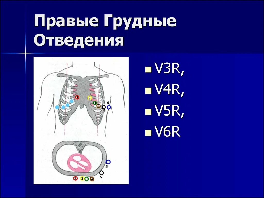 Грудные отведения на ЭКГ электроды. Правые грудные отведения v4r. Правые грудные отведения на ЭКГ. Электрокардиография грудные отведения. Правые грудные отведения