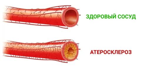 Атеросклероз верхних