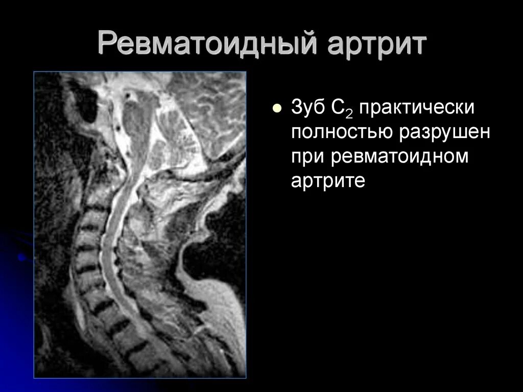 Болезнь бехтерева поражение суставов. Ревматоидный артрит суставные проявления. Артрит это заболевание костей. Ревматоидный артрит позвоночника мрт. Спондилит грудного отдела позвоночника.