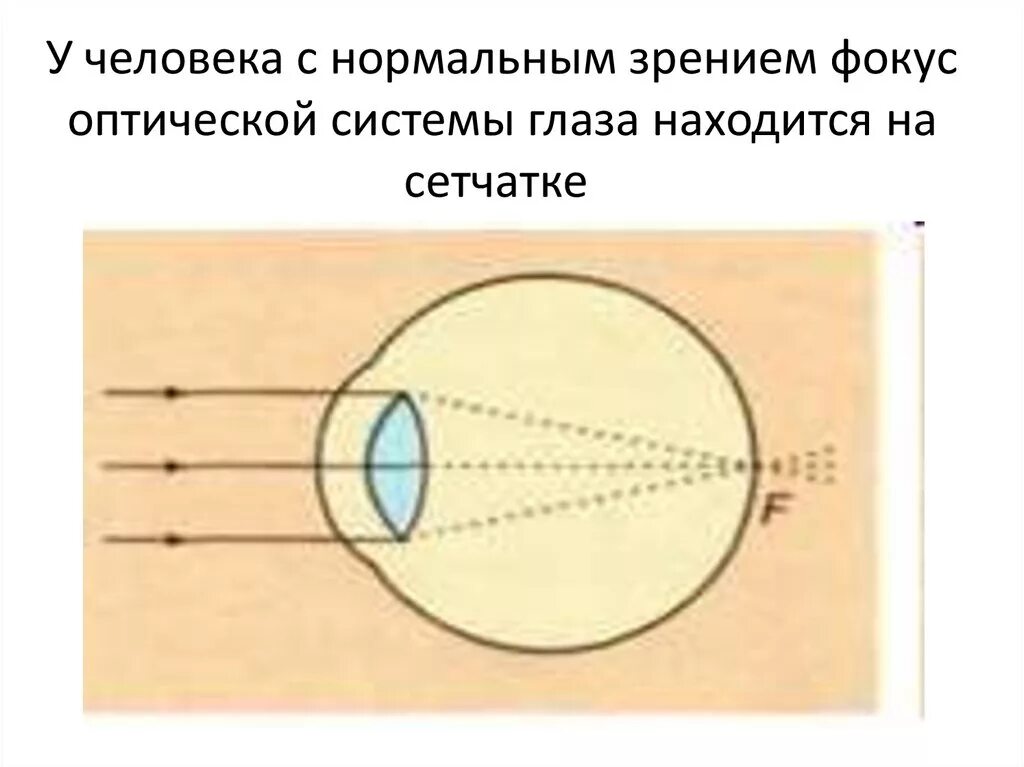Оптическая система нормального глаза. Изображение на сетчатке глаза. Фокус оптической системы глаза. Оптическая схема глаза человека. Нормальный глаз схема