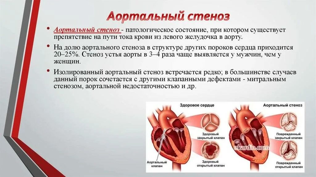 Стеноз аортального клапана сердца. Порок сердца стеноз аортального клапана. митральные пороки сердца (стеноз, недостаточность. атеросклеротический порок аортального клапана. стеноз аортального клапана 2 степени.