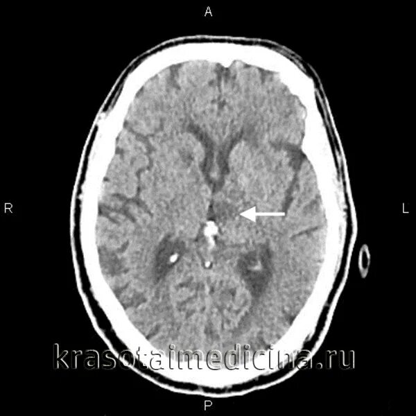 Ишемический инфаркт мозга кт. Инфаркт головного мозга кт. Зона отека головного мозга на кт. Кт острая стадия ишемического инсульта. Инфаркт мозга кт.