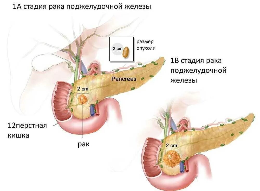 Есть при раке поджелудочной железы. Опухоль головки поджелудочной железы синдром. Опухоли поджелудочной железы 4 стадии. Тумор головки поджелудочной железы. Онкопатологии поджелудочной железы.