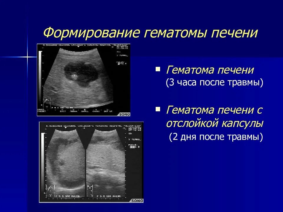 Подкапсульная гематома печени на УЗИ. Гематома селезенки на УЗИ. Гематома в стадии организации