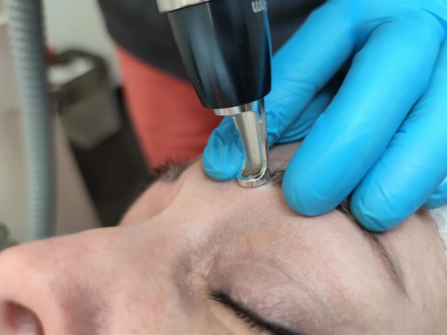 Удаление татуажа бровей лазером. Что лучше радиоволновое или лазерное удаление новообразований. Прижигание родинок лазером. Иссечение родинки лазером. Электрокоагуляция папиллом.