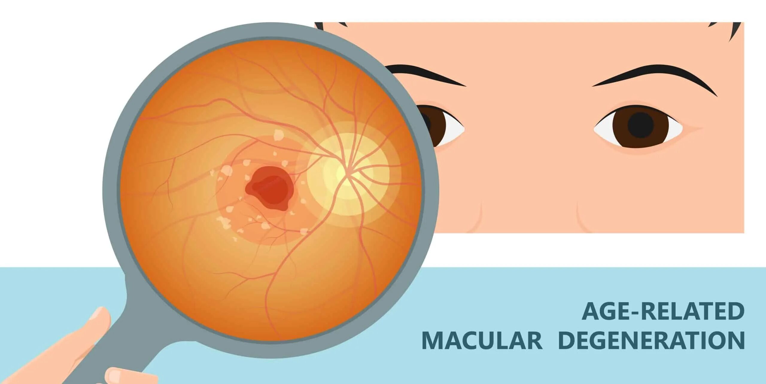 Macular Degeneration картинки глаз. Ретинопатия недоношенных.