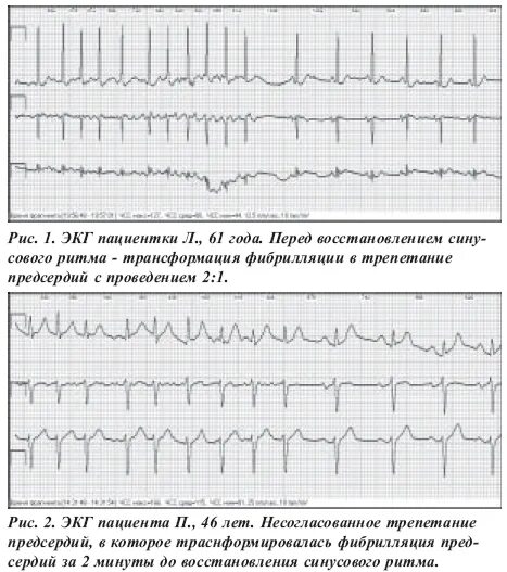 Фибрилляция предсердий на экг. Пароксизм фибрилляции на экг. Кардиограмма при фибрилляции предсердий. Фибрилляция предсердий заключение. Фибрилляция предсердий тахисистолическая на экг.