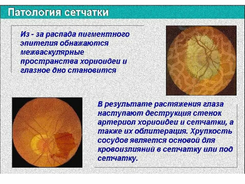 Аномалии сетчатки глаза. Врожденные аномалии сетчатки. Диагноз сетчатки