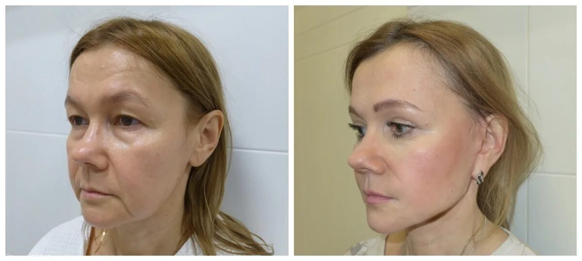 Операция смас лифтинг операция. Смас лифтинг операционный. Смас пластика. Смас пластика. Смас пластика.