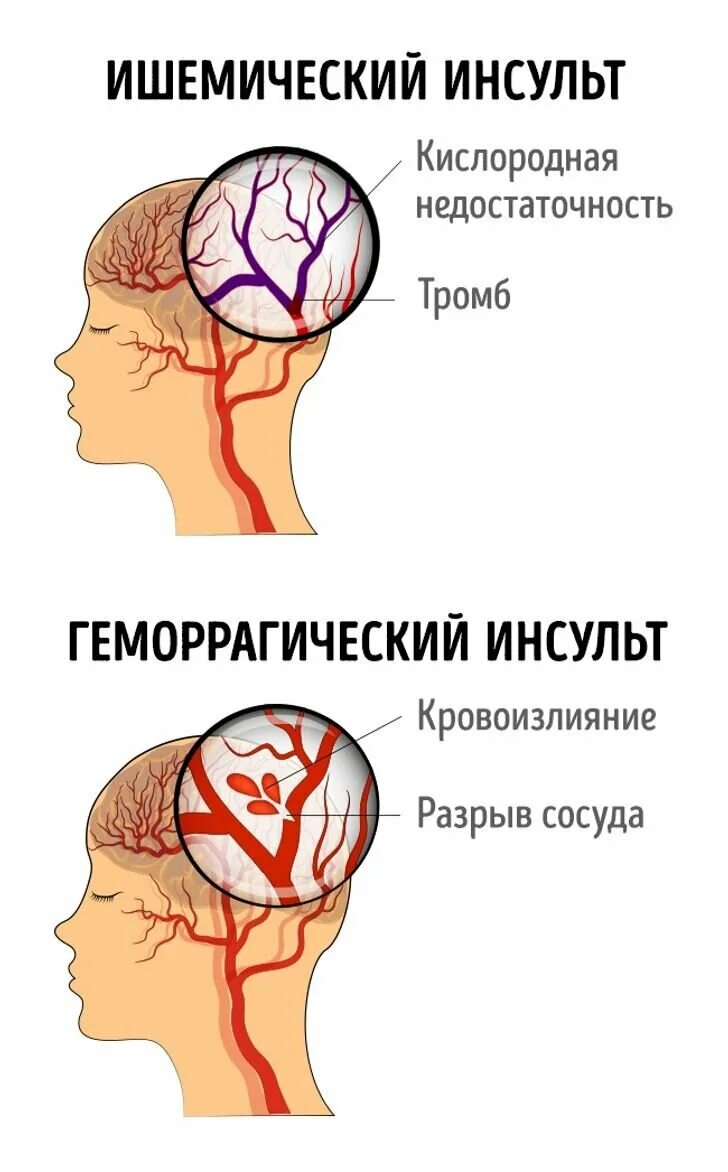 Где находится инсульт. Инсульт.