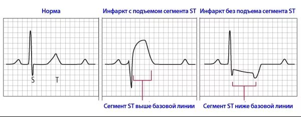 Экг подъем. Окс с подъемом сегмента St ЭКГ. ОИМ без подъема сегмента St ЭКГ. Инфаркт с подъемом сегмента St ЭКГ. Острый коронарный синдром с подъемом сегмента St ЭКГ.