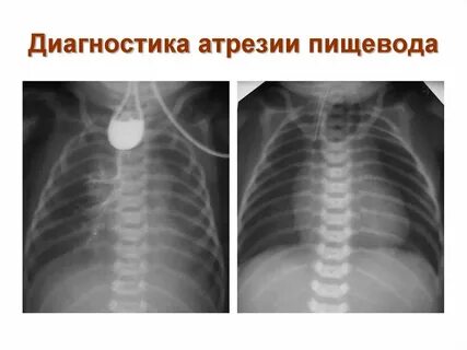 Атрезия