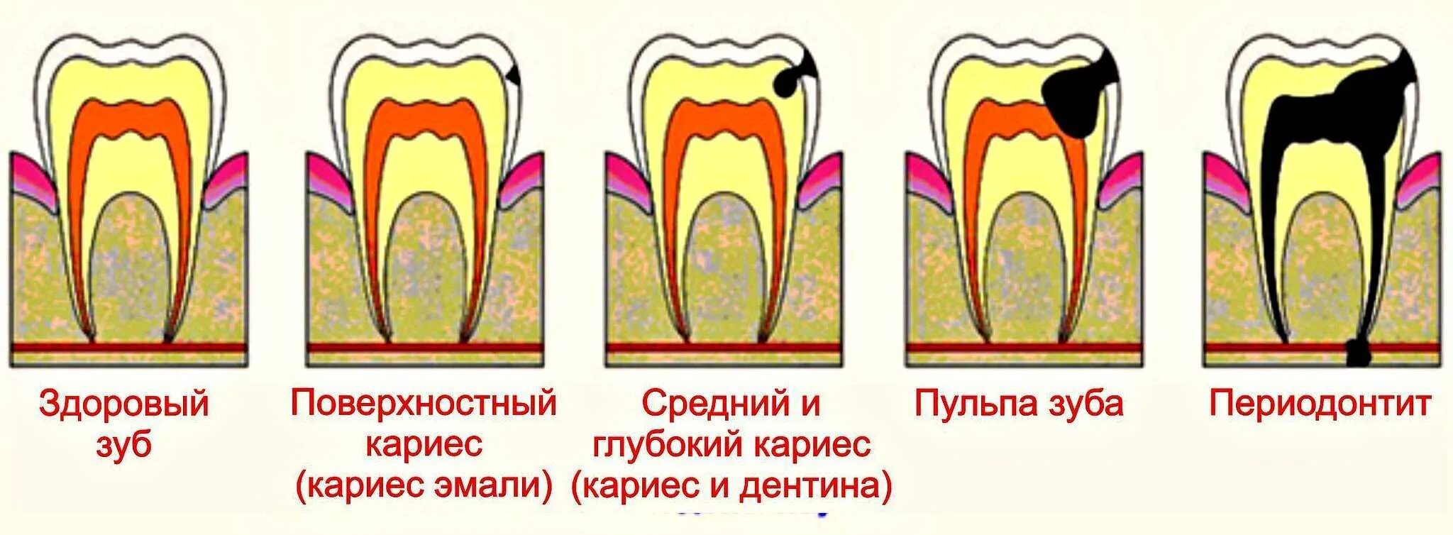 Сколько развивается кариес. Кариес пульпит периодонтит. классификация кариес пульпит периодонтит. строение зуба кариес пульпит.