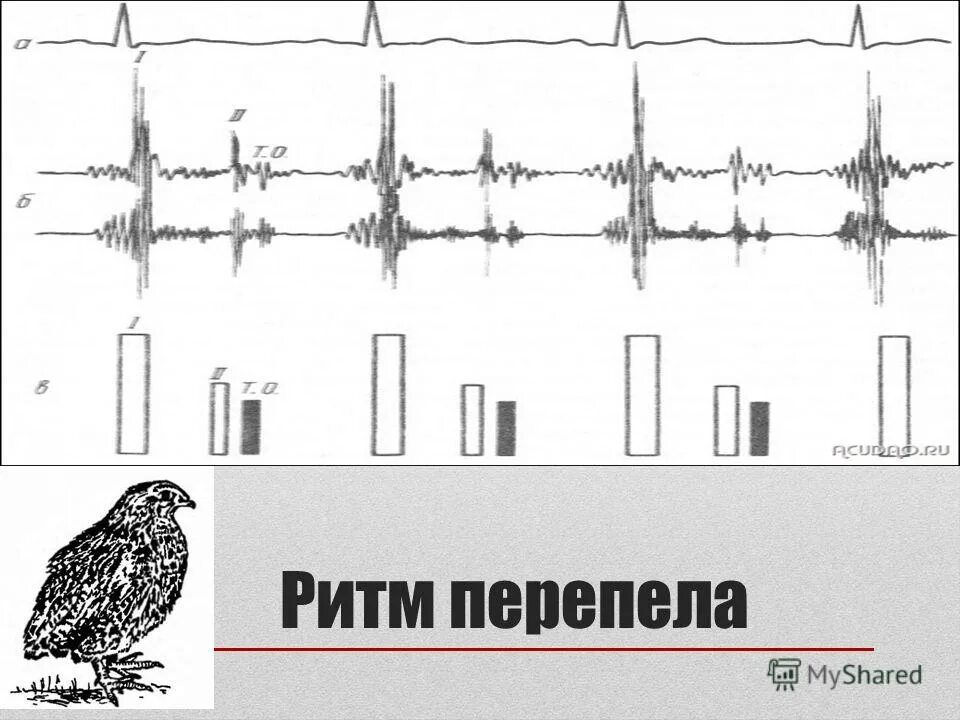Схема ритм. Фонокардиограмма ритма перепела. ритм перепела фкг. ритм перепела при митральном. ритм перепела при митральном стенозе.