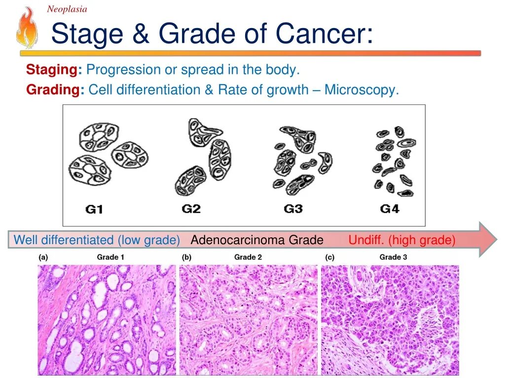 Неоплазия lo v Grade. Gleason классификация. Stages of cancer