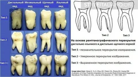 Корни нижних моляров