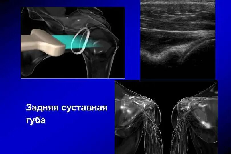 Повреждение губы плечевого сустава. Суставная губа плечевого сустава разрыв. Повреждение суставной губы плечевого сустава. Разрыв гленоида плечевого сустава на мрт.