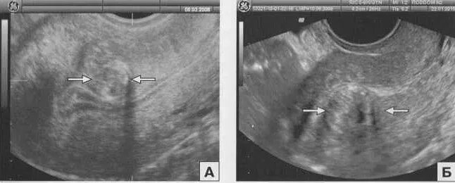 Субмукозная миома матки УЗИ.
