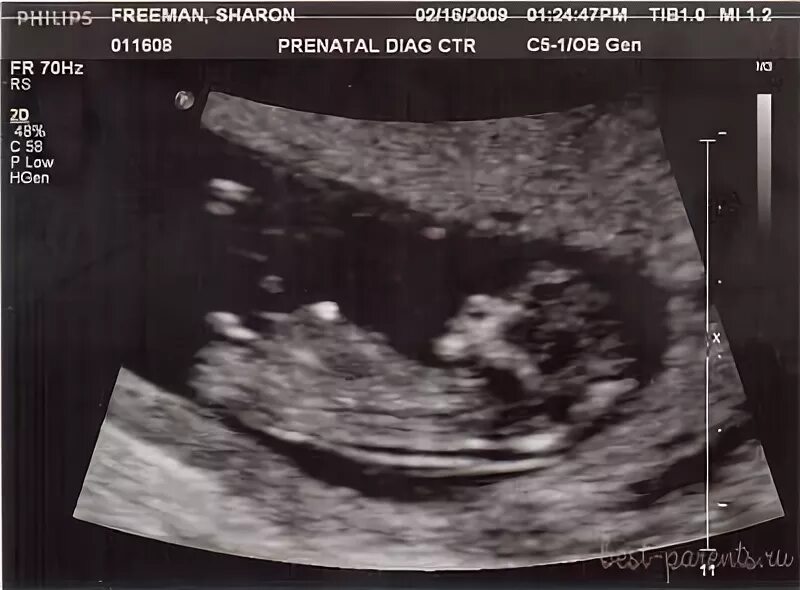 Фото мальчика 12 недель. УЗИ 12 недель беременности мальчик. Пол плода на УЗИ В 12 недель беременности. УЗИ 14 недель беременности мальчик. Узим мальчик 13 недель беременности.