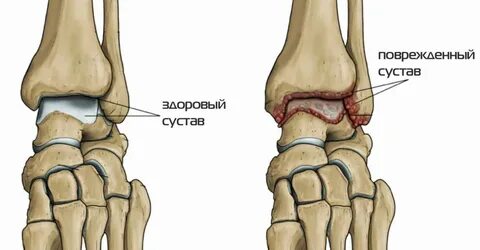 Остеоартроз голеностопного сустава 1 степени