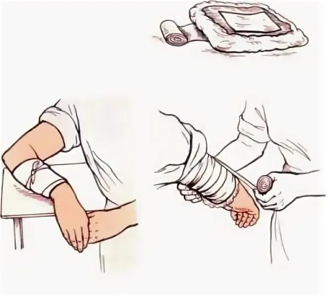 Техника наложения компресса. Наложение компресса алгоритм. Накладывание компресса алгоритм. Согревающий компресс. Постановка холодного компресса.